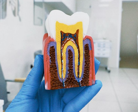 Is It Painful to Have a Root Canal?